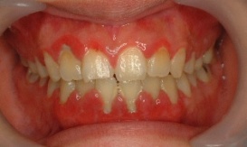 歯垢の蓄積による歯肉炎