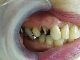 審美的ジルコニアクラウン　術前