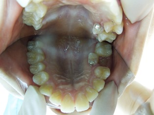 内側に生えてきた永久歯　治療前