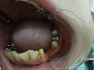 奥歯のジルコニアブリッジ　治療前