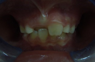 前歯の交差交合