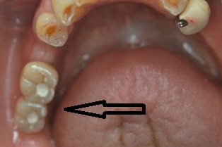 下顎の奥歯にインプラント