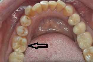 奥歯の大きな欠損・虫歯にジルコニア
