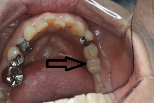 下の奥歯にインプラントをセット