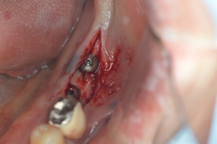 下の奥歯の場所に２本インプラント