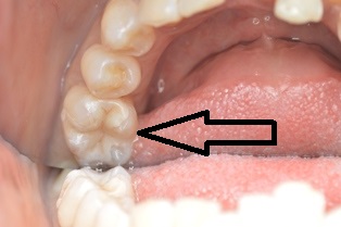 下の奥歯にジルコニアインレーをセット