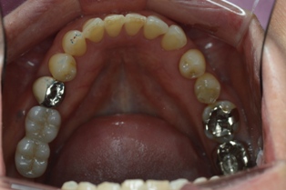 下顎の奥歯にインプラントとふるジルコニアクラウン
