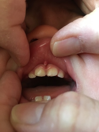 子供の転倒による口腔内の外傷