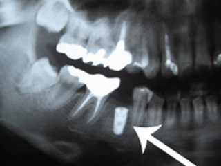 右下抜歯部に１本のインプラントを埋入