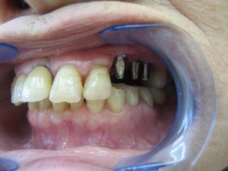 犬歯、小臼歯のインプラント