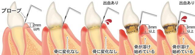 歯周ポケット 歯周ポケット
