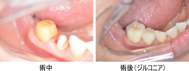 美しい白い歯にする治療